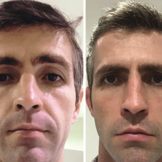 Máscara Coreana de Colágeno Rejuvenescedora Peel Off - Collagen Fit™